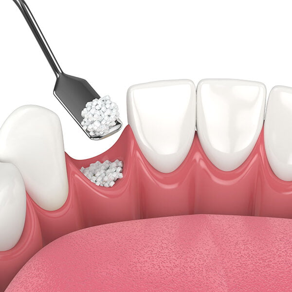 Bone Grafting Procedure