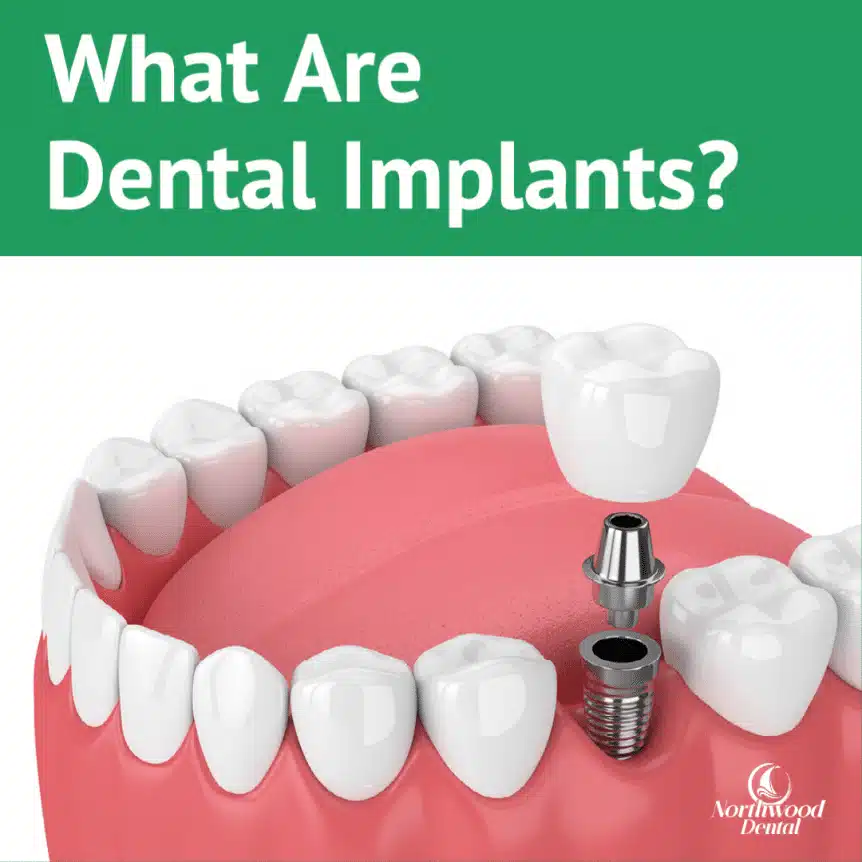 What Are Dental Implants?