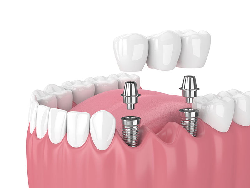 Dental implants Clearwater FL