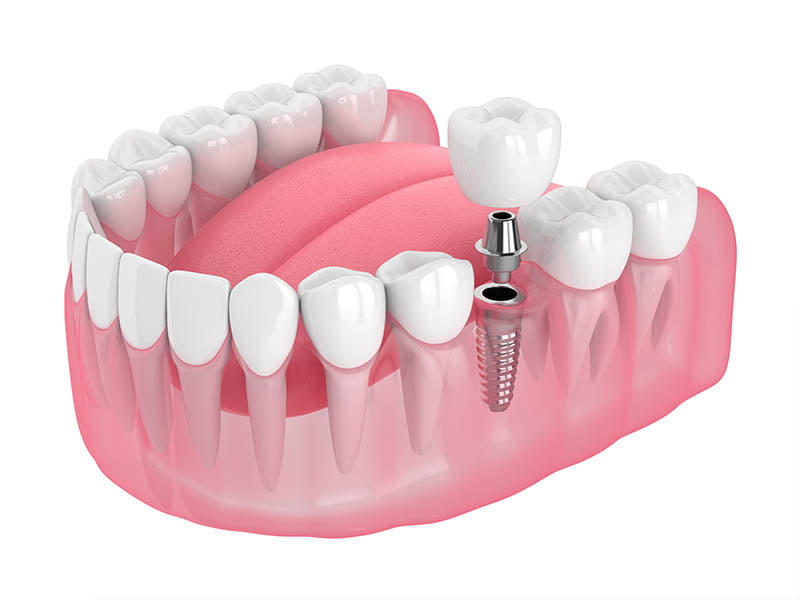 Dental Implants near me
