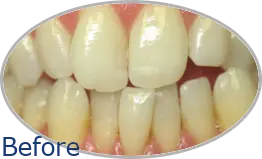 Smile-Gallery_Invisalign-Gallery_Aaron-S-L-Before_FINAL_Edited_Text.png