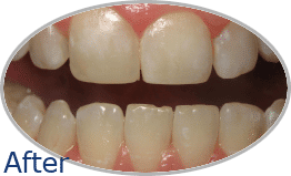 Smile-Gallery_Invisalign-Gallery_Allyson-A-After_FINAL_Edited_Text