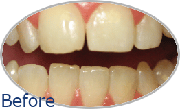 Smile-Gallery_Invisalign-Gallery_Allyson-A-Before_FINAL_Edited_Text