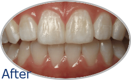 Smile-Gallery_Invisalign-Gallery_An-D-After_FINAL_Edited_Text