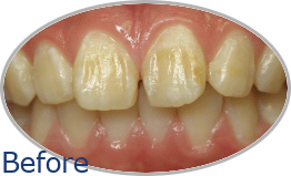 Smile-Gallery_Invisalign-Gallery_An-D-Before_FINAL_Edited_Text