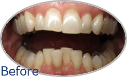 Smile-Gallery_Invisalign-Gallery_Barb-M-Before-Invisalign_FINAL_Edited_Text.png