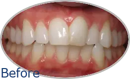 Smile-Gallery_Invisalign-Gallery_Charles-S-Before-Invisalign_FINAL_Edited_Text.png