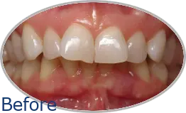 Smile-Gallery_Invisalign-Gallery_Charlotte-S-Before-Invisalign_FINAL_Edited_Text.png