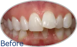 Smile-Gallery_Invisalign-Gallery_Emily-H-Before-Invisalign_FINAL_Edited_Text.png