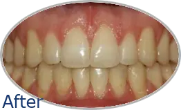 Smile-Gallery_Invisalign-Gallery_Invisalign-3-After_FINAL_Edited_Text.png