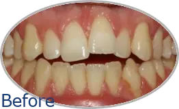 Smile-Gallery_Invisalign-Gallery_Invisalign-3-Before_FINAL_Edited_Text.png