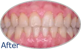 Smile-Gallery_Invisalign-Gallery_Invisalign-4-After_FINAL_Edited_Text.png