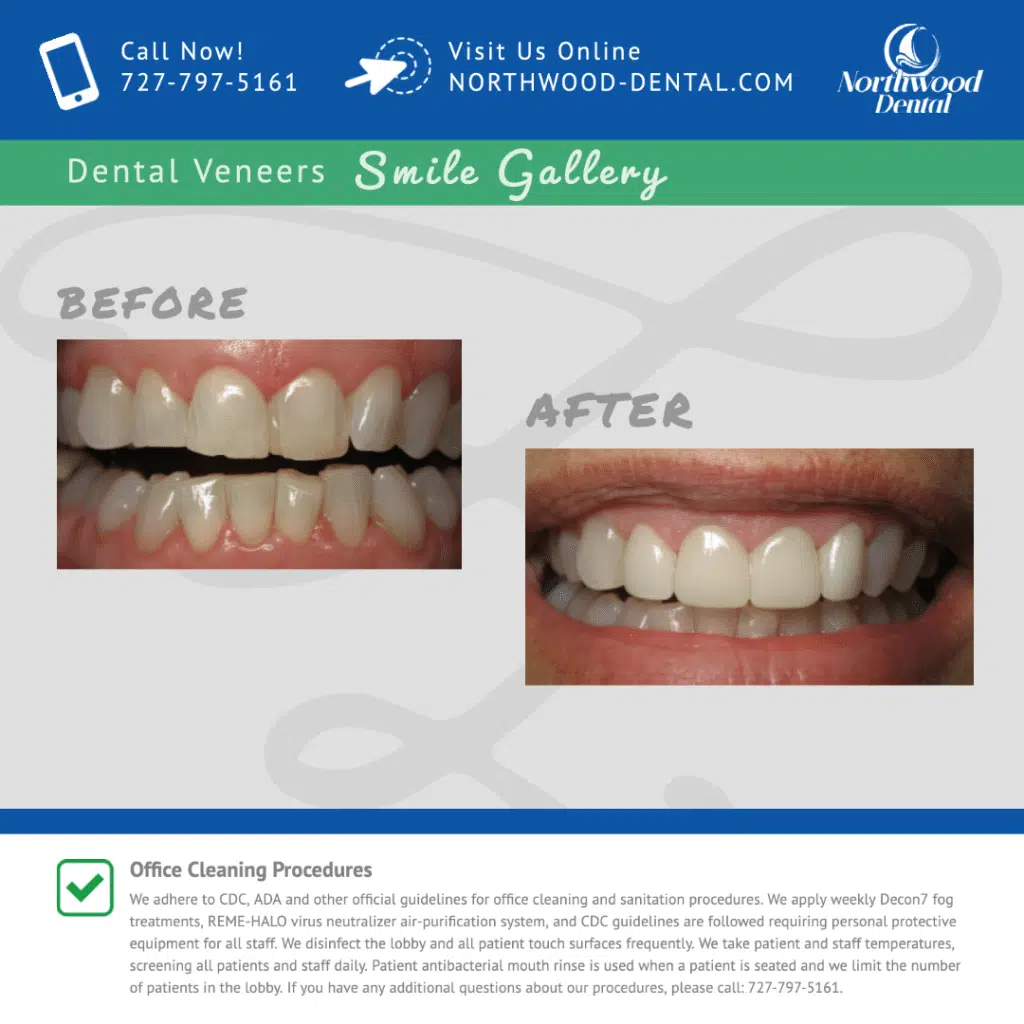 Dental Veneers – Before & After